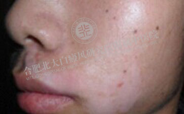 白癜風(fēng)康復(fù) 男孩快樂(lè)成長(zhǎng)