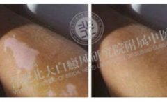他把學(xué)生視作一切 可是自己卻被白斑困擾著