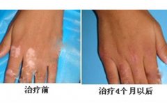 手背上的白癜風(fēng)什么時候能痊愈