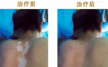 合肥白癜風(fēng)患者復(fù)色案例