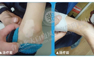 白癜風，我終于徹底擺脫你