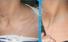 合肥白癜風(fēng)患者復(fù)色案例