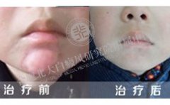 合肥白癜風(fēng)患者復(fù)色案例